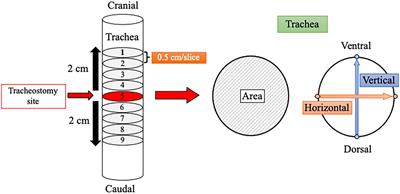 Association between surgical tracheostomy and chronic tracheal stenosis: A retrospective, single-center study